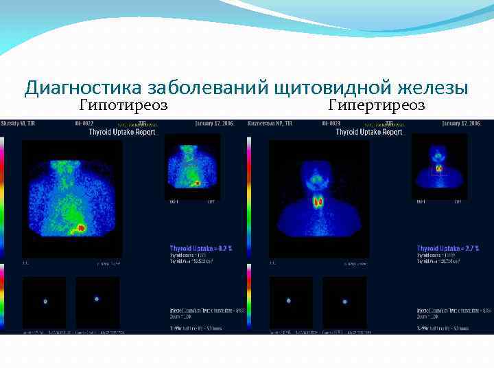 Диагностика заболеваний щитовидной железы Гипотиреоз Гипертиреоз 