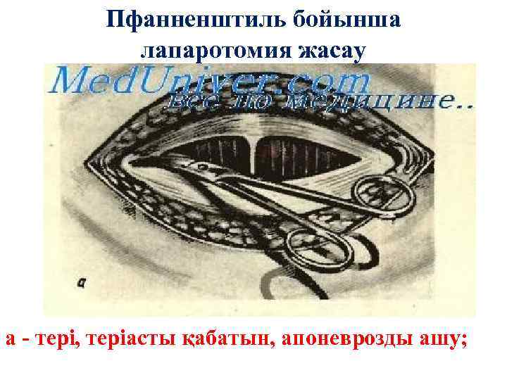 Пфанненштиль бойынша лапаротомия жасау а - тері, теріасты қабатын, апоневрозды ашу; 