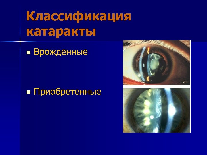 Классификация катаракты n Врожденные n Приобретенные 