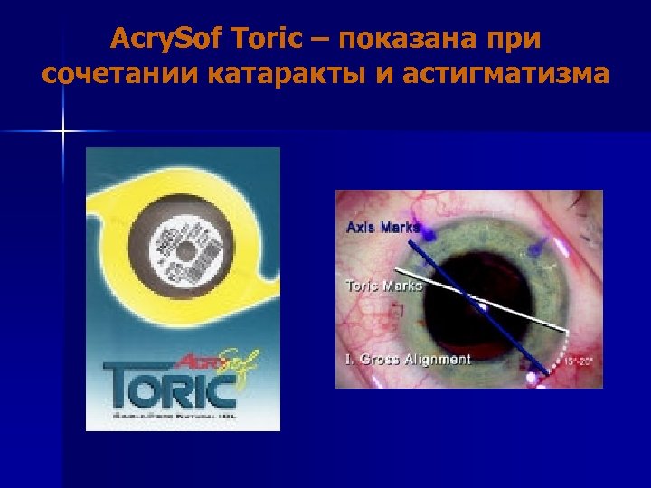 Acry. Sof Toric – показана при сочетании катаракты и астигматизма 