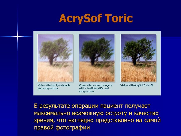 Acry. Sof Toric В результате операции пациент получает максимально возможную остроту и качество зрения,