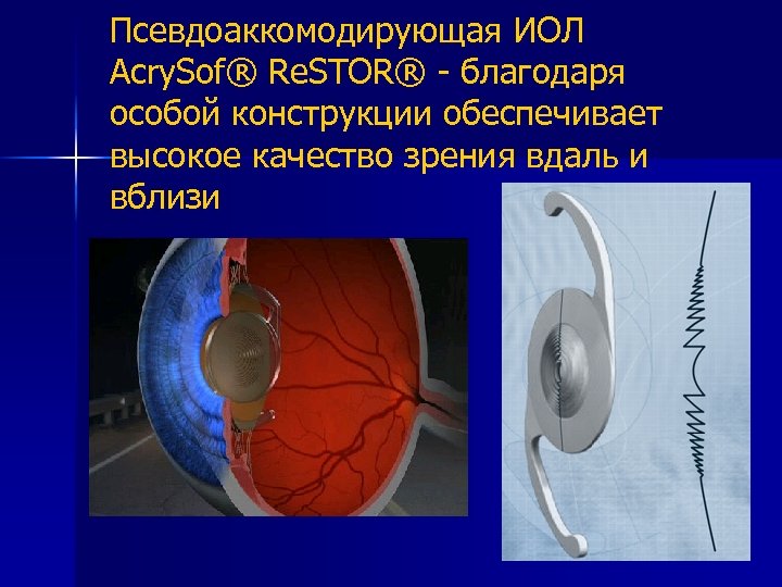 Псевдоаккомодирующая ИОЛ Acry. Sof® Re. STOR® - благодаря особой конструкции обеспечивает высокое качество зрения