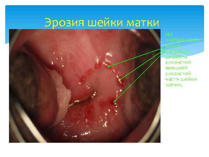 Эрозия шейки матки На изображении видны язвенные дефекты слизистой внешней слизистой части шейки матки.