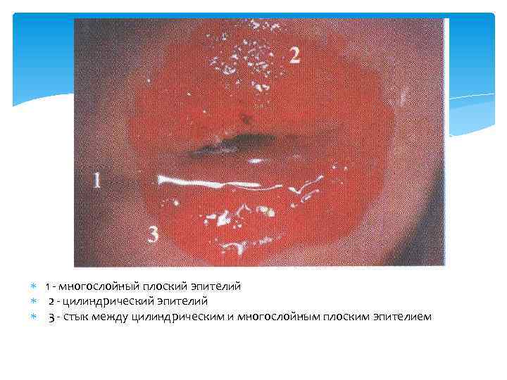  1 - многослойный плоский эпителий 2 - цилиндрический эпителий 3 - стык между