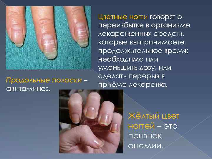 Продольные полоски – авитаминоз. Цветные ногти говорят о переизбытке в организме лекарственных средств, которые