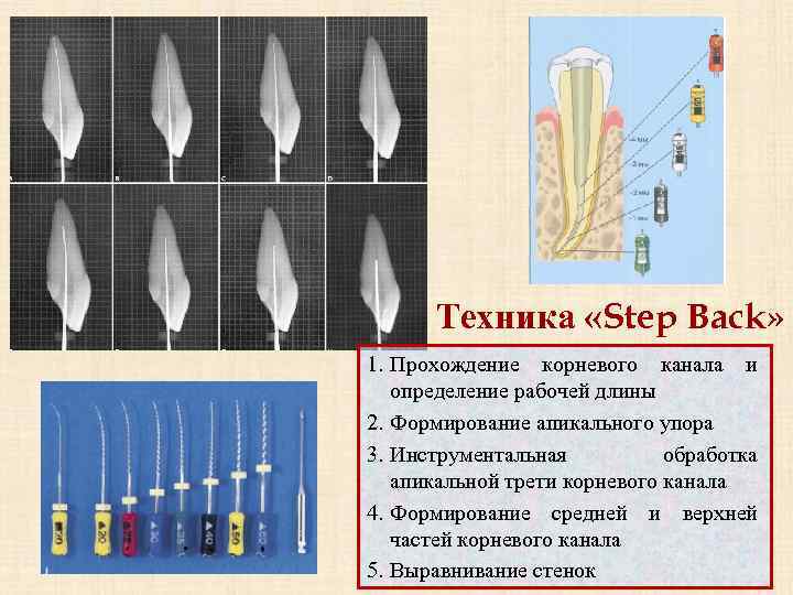 Трети корневого канала