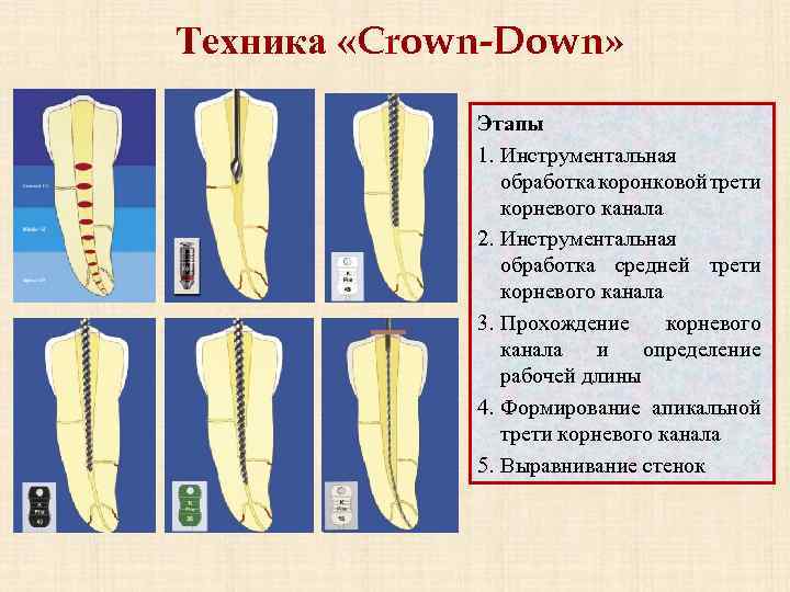 Трети корневого канала