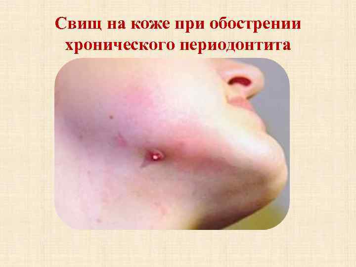Свищ на коже при обострении хронического периодонтита 