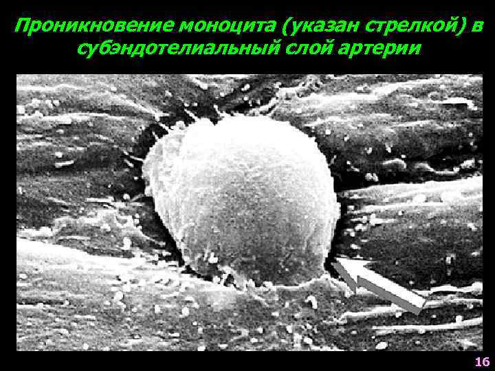 Проникновение моноцита (указан стрелкой) в субэндотелиальный слой артерии 16 