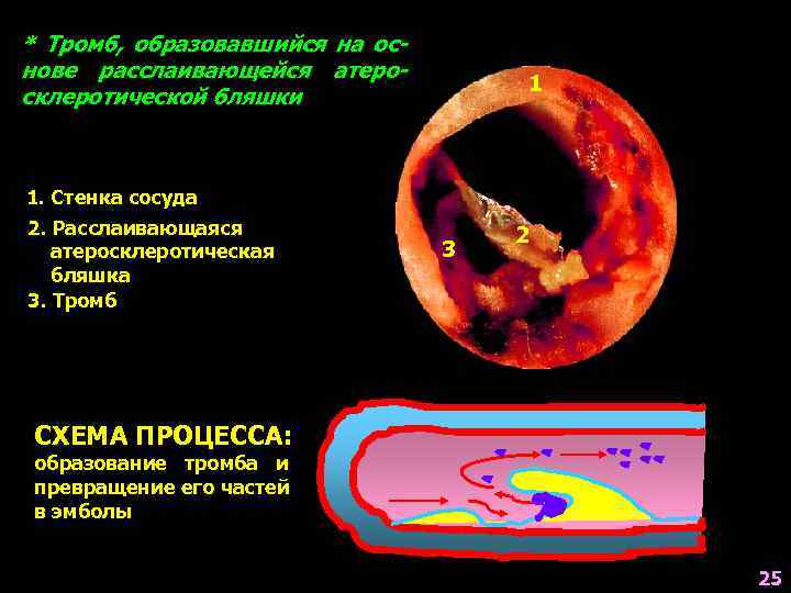 * Тромб, образовавшийся на основе расслаивающейся атеросклеротической бляшки 1 1. Стенка сосуда 2. Расслаивающаяся