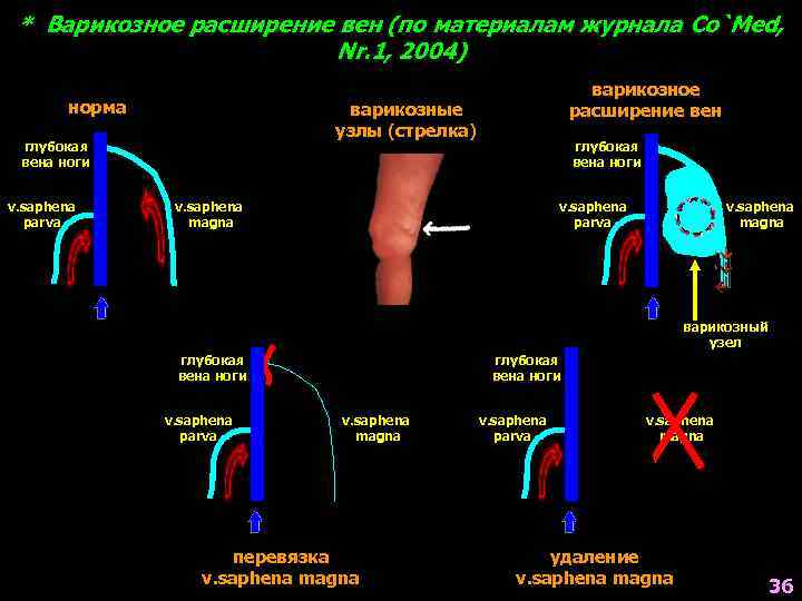 * Варикозное расширение вен (по материалам журнала Co`Med, Nr. 1, 2004) норма варикозные узлы