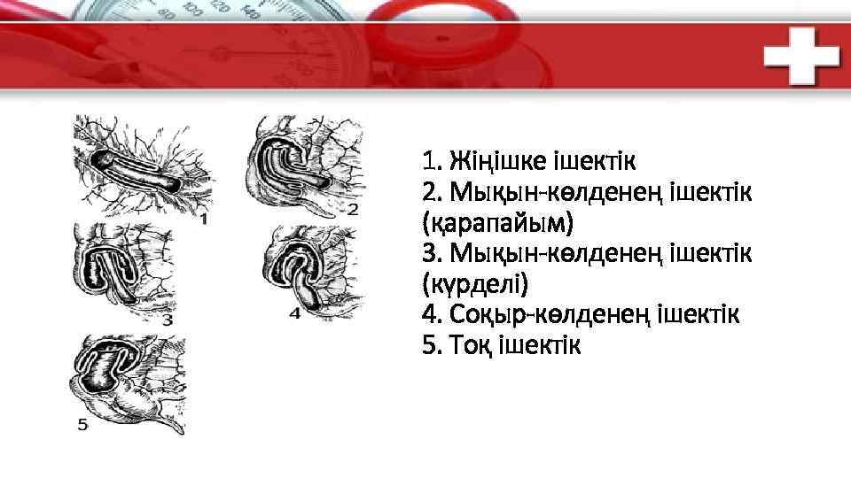 1. Жіңішке ішектік 2. Мықын-көлденең ішектік (қарапайым) 3. Мықын-көлденең ішектік (күрделі) 4. Соқыр-көлденең ішектік