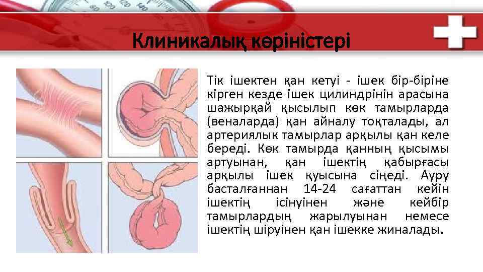 Клиникалық көріністері Тік ішектен қан кетуі - ішек бір-біріне кірген кезде ішек цилиндрінін арасына