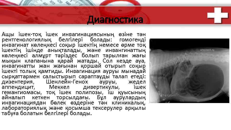 Диагностика Ащы ішек-тоқ ішек инвагинациясының өзіне тән рентгенологиялық белгілері болады: гомогенді инвагинат көлеңкесі соқыр