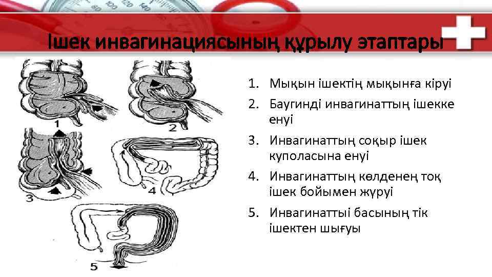 Ішек инвагинациясының құрылу этаптары 1. Мықын ішектің мықынға кіруі 2. Баугинді инвагинаттың ішекке енуі