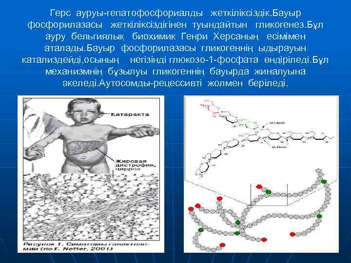 Герс ауруы-гепатофосфориалды жеткіліксіздік. Бауыр фосфорилазасы жеткіліксіздігінен туындайтын гликогенез. Бұл ауру бельгиялық биохимик Генри Херсаның
