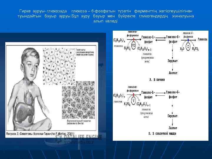 Гирке ауруы- глюкозада глюкоза – 6 -фосфатын түзетін ферменттің жетіспеушілігінен туындайтын бауыр ауруы. Бұл
