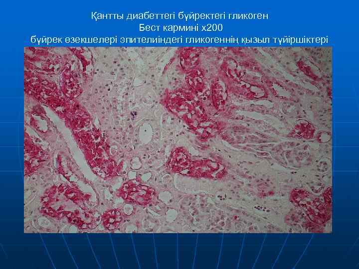 Қантты диабеттегі бүйректегі гликоген Бест кармині х200 бүйрек өзекшелері эпителиіндегі гликогеннің қызыл түйіршіктері 