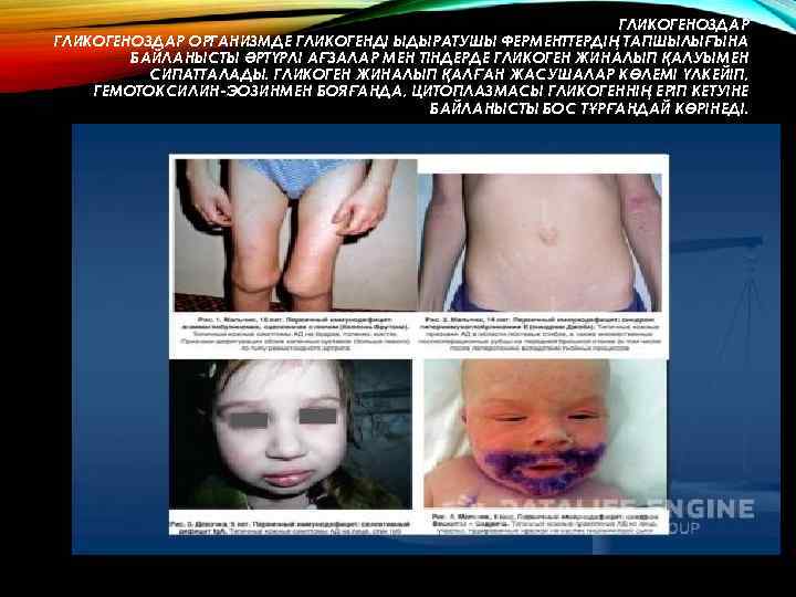 ГЛИКОГЕНОЗДАР ОРГАНИЗМДЕ ГЛИКОГЕНДІ ЫДЫРАТУШЫ ФЕРМЕНТТЕРДІҢ ТАПШЫЛЫҒЫНА БАЙЛАНЫСТЫ ӘРТҮРЛІ АҒЗАЛАР МЕН ТІНДЕРДЕ ГЛИКОГЕН ЖИНАЛЫП ҚАЛУЫМЕН