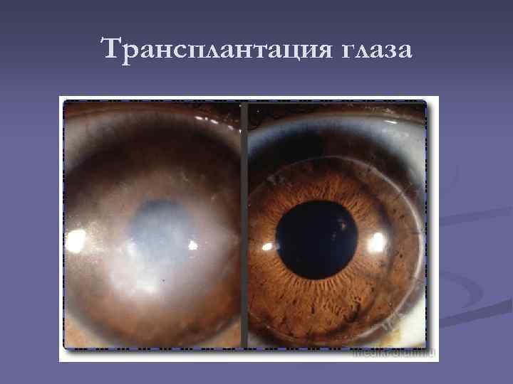 Трансплантация глаза 