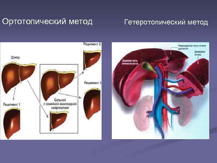 Ортотопический метод Гетеротопический метод 