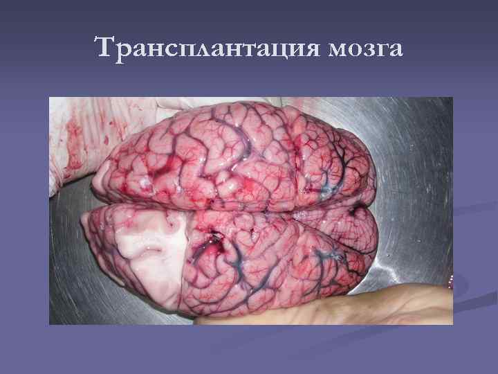 Трансплантация мозга 