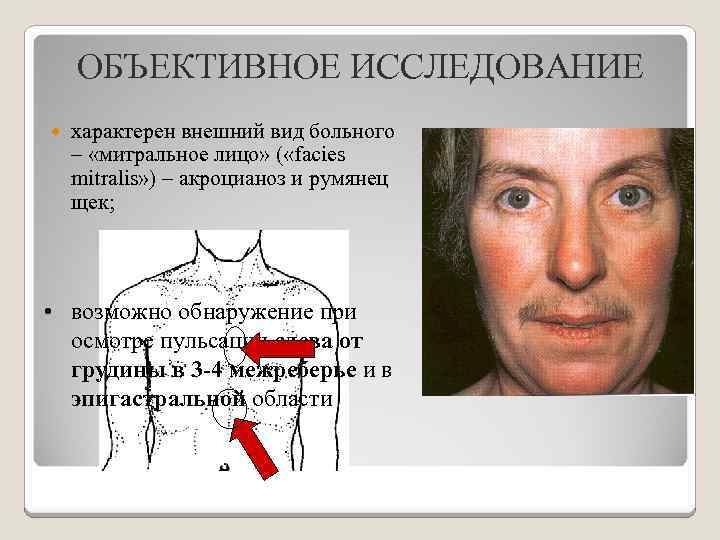 ОБЪЕКТИВНОЕ ИССЛЕДОВАНИЕ характерен внешний вид больного – «митральное лицо» ( «facies mitralis» ) –