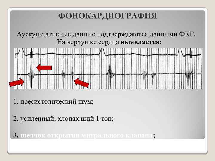 Аускультативная картина при митральном стенозе сердца включает тест