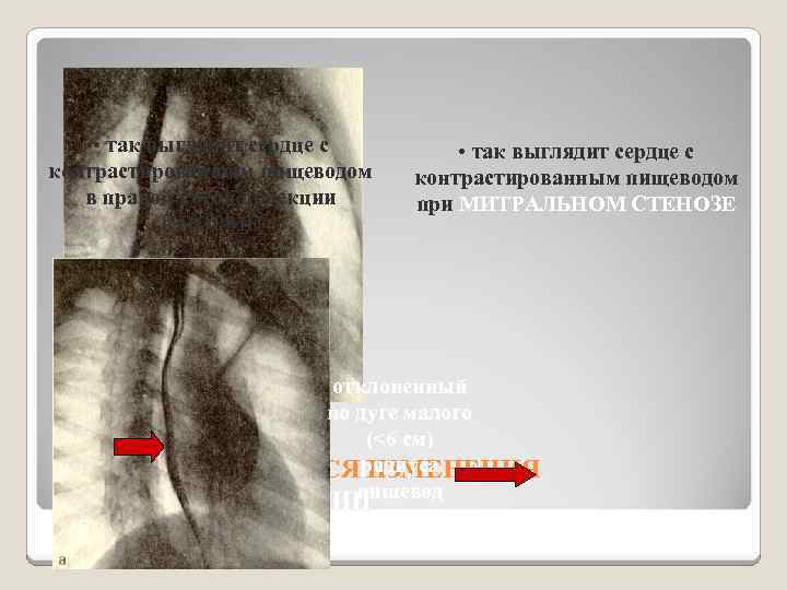  • так выглядит сердце с контрастированным пищеводом в правой косой проекции в НОРМЕ