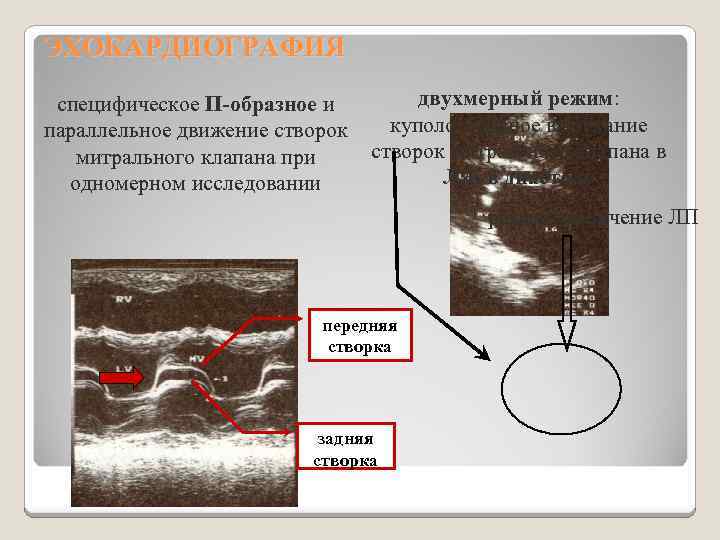 ЭХОКАРДИОГРАФИЯ специфическое П-образное и параллельное движение створок митрального клапана при одномерном исследовании двухмерный режим: