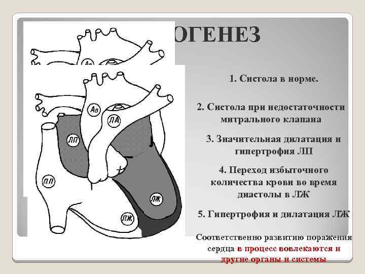 ПАТОГЕНЕЗ 1. Систола в норме. 2. Систола при недостаточности митрального клапана 3. Значительная дилатация
