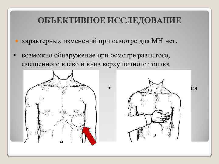 ОБЪЕКТИВНОЕ ИССЛЕДОВАНИЕ характерных изменений при осмотре для МН нет. • возможно обнаружение при осмотре