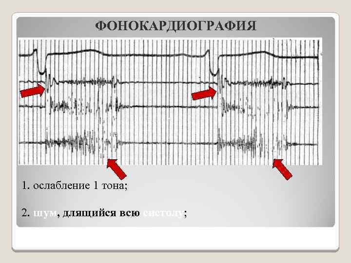 Аускультативная картина митральной недостаточности