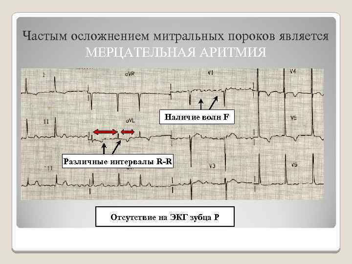 Частым осложнением митральных пороков является МЕРЦАТЕЛЬНАЯ АРИТМИЯ Наличие волн F Различные интервалы R-R Отсутствие
