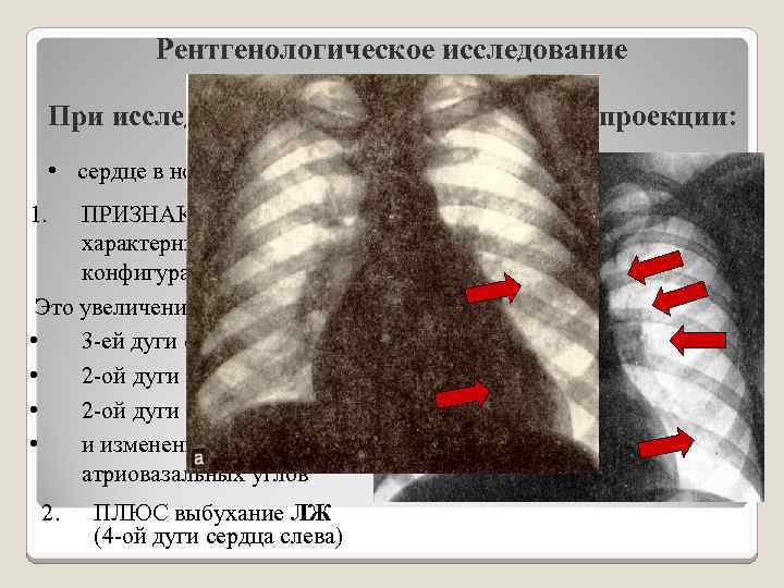 Рентгенологическое исследование При исследовании тени сердца в прямой проекции: • сердце в норме 1.