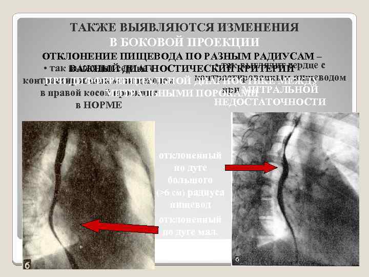 ТАКЖЕ ВЫЯВЛЯЮТСЯ ИЗМЕНЕНИЯ В БОКОВОЙ ПРОЕКЦИИ ОТКЛОНЕНИЕ ПИЩЕВОДА ПО РАЗНЫМ РАДИУСАМ – • так