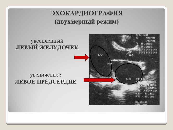 ЭХОКАРДИОГРАФИЯ (двухмерный режим) увеличенный ЛЕВЫЙ ЖЕЛУДОЧЕК увеличенное ЛЕВОЕ ПРЕДСЕРДИЕ 
