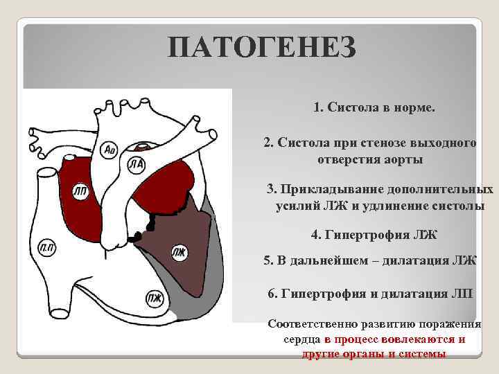 ПАТОГЕНЕЗ 1. Систола в норме. 2. Систола при стенозе выходного отверстия аорты 3. Прикладывание