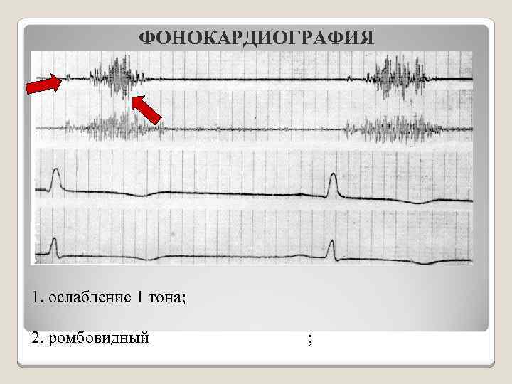 ФОНОКАРДИОГРАФИЯ Аускультативные данные подтверждаются данными ФКГ. При постановке микрофона во 2 -ое межреберье справа