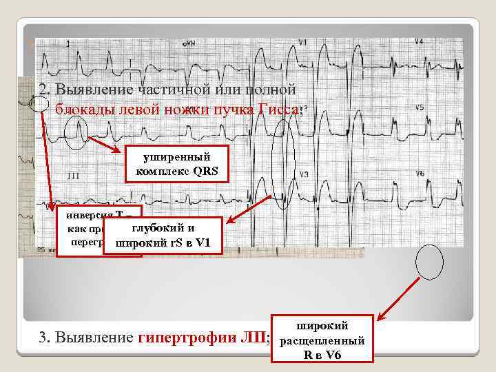 ЭЛЕКТРОКАРДИОГРАФИЯ 1. Выявление гипертрофии ЛЖ; 2. Выявление частичной или полной блокады левой ножки пучка