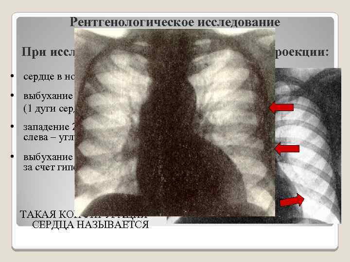 Тень сердца расширена