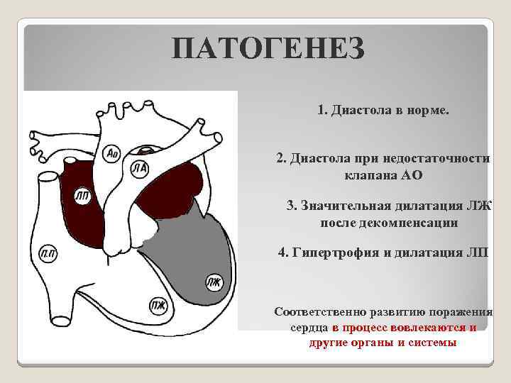 ПАТОГЕНЕЗ 1. Диастола в норме. 2. Диастола при недостаточности клапана АО 3. Значительная дилатация