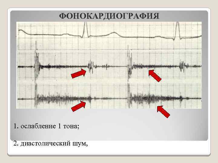 ФОНОКАРДИОГРАФИЯ Аускультативные данные подтверждаются данными ФКГ. При постановке микрофона во 2 -ое межреберье справа