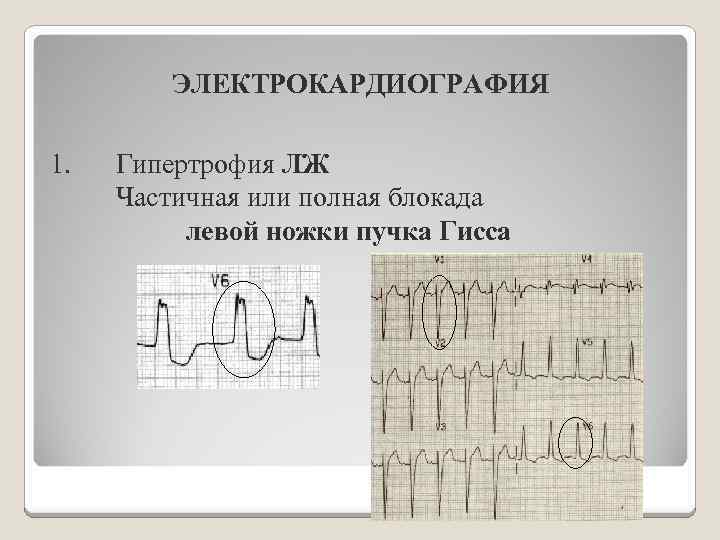 ЭЛЕКТРОКАРДИОГРАФИЯ 1. Гипертрофия ЛЖ Частичная или полная блокада левой ножки пучка Гисса 