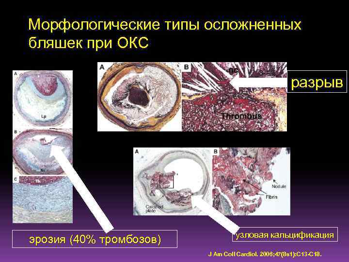 Морфологические типы осложненных бляшек при ОКС разрыв эрозия (40% тромбозов) узловая кальцификация J Am