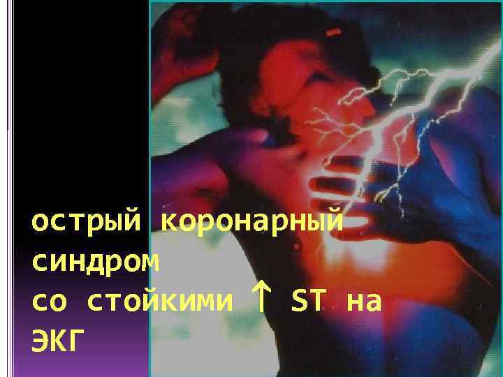 острый коронарный синдром со стойкими ST на ЭКГ 