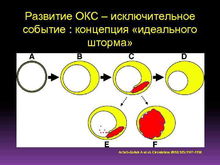 Развитие острого коронарного синдрома