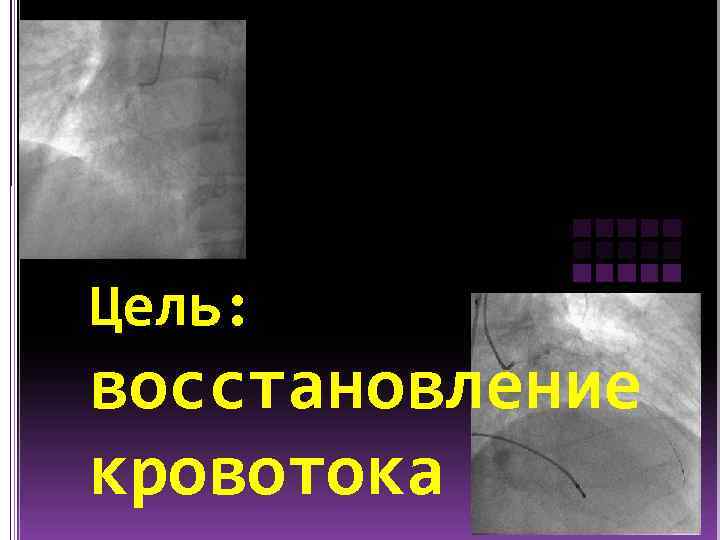 Цель: восстановление кровотока 