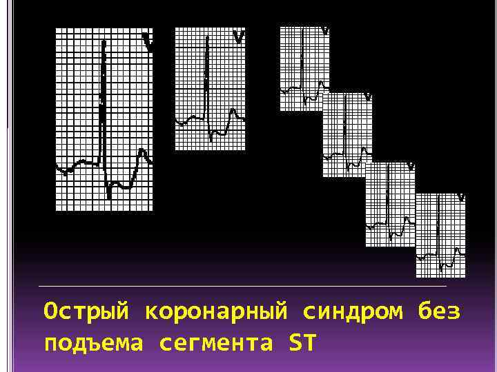 Острый коронарный синдром без подъема сегмента ST 