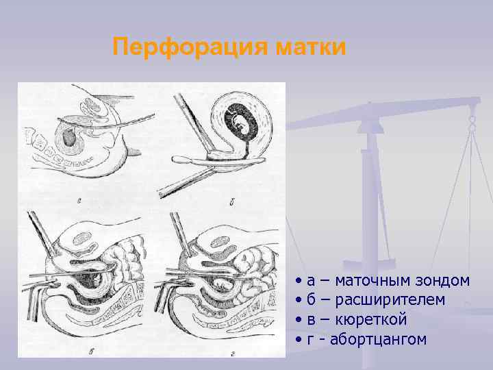 Перфорация матки • а – маточным зондом • б – расширителем • в –